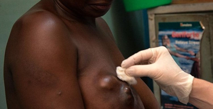 Abagabo barwaye Kanseri y'ibere ngo baribazi ko ituruka mu Mashereka gusa