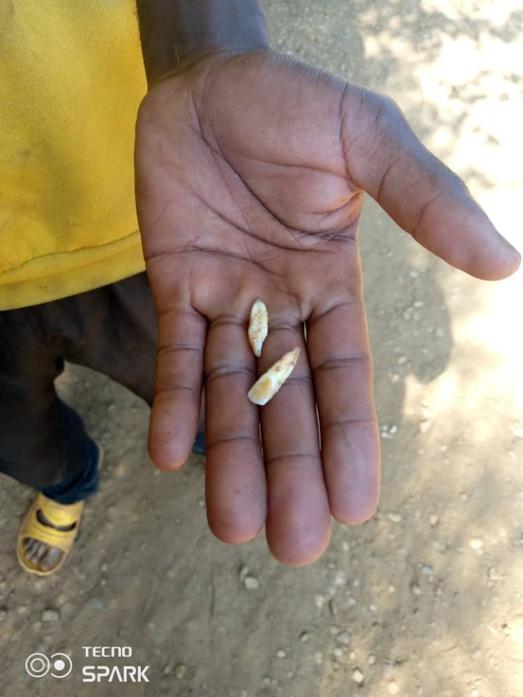 Kigali: Umugore yakubise Umugabo we amukura amenyo abiri